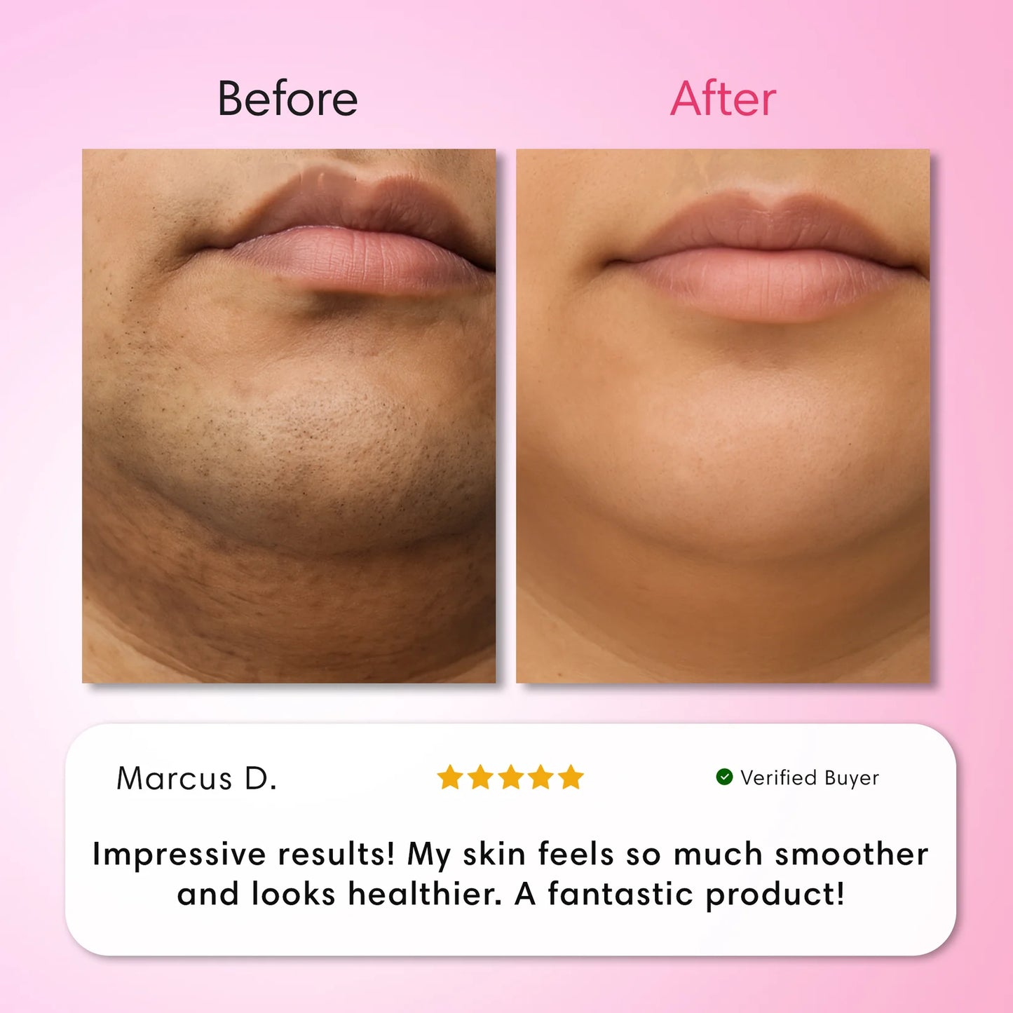 LumeLux Hair Removal Trilogy Kit