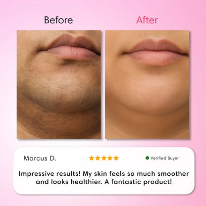 LumeLux Hair Removal Trilogy Kit