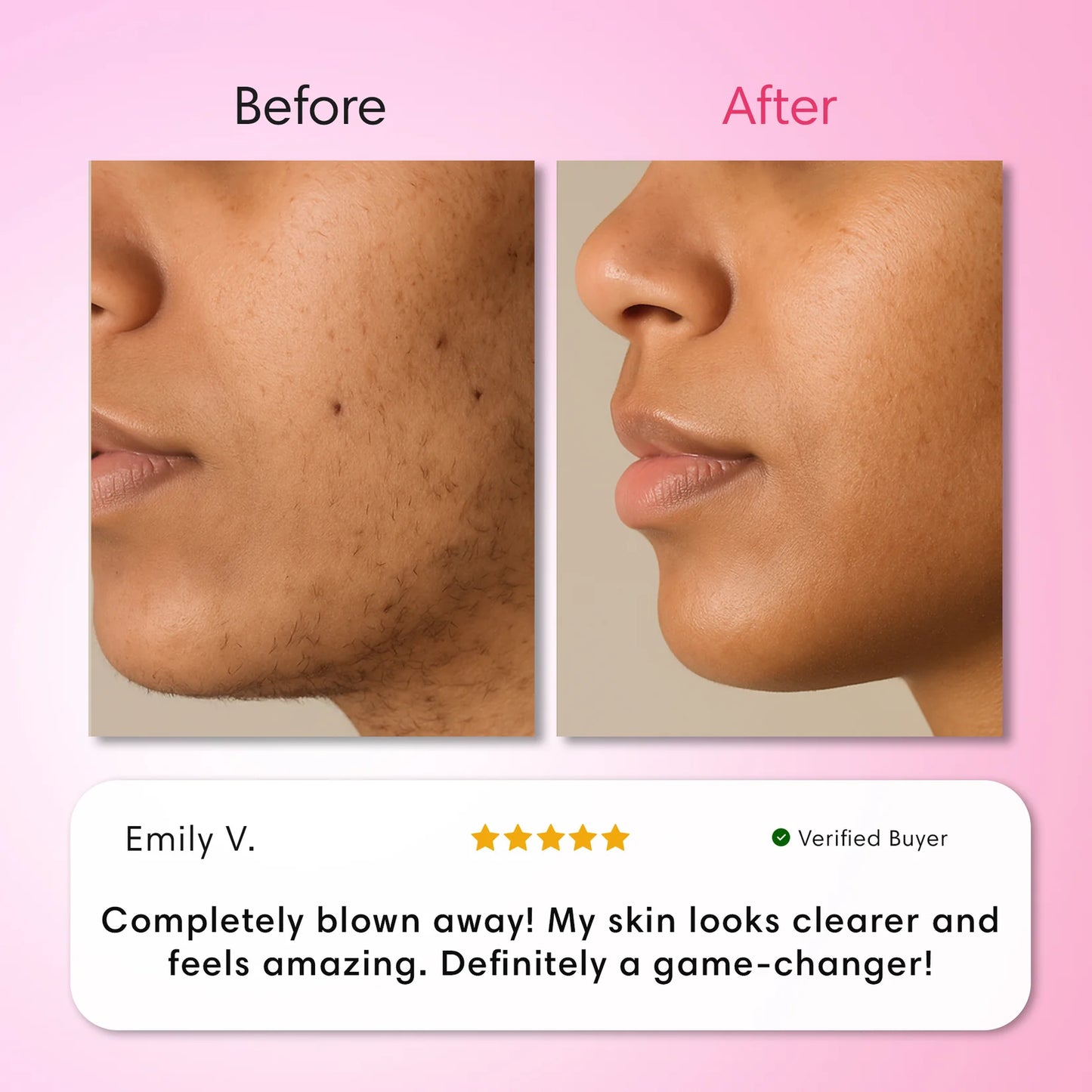 LumeLux Hair Removal Trilogy Kit